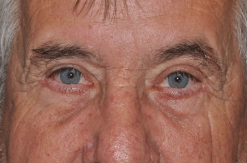 Facelift Before & After Image