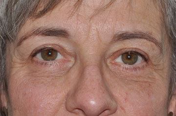 Facelift Before & After Image