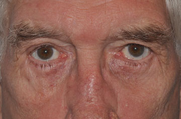 Facelift Before & After Image