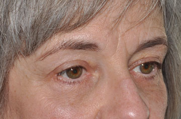 Facelift Before & After Image