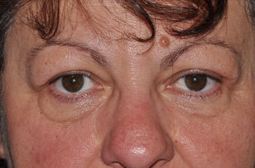 Facelift Before & After Image
