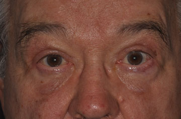 Facelift Before & After Image