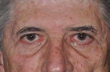 Facelift Before & After Image