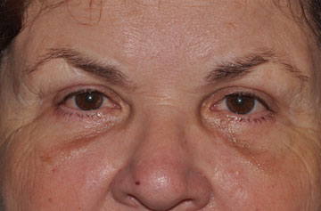 Facelift Before & After Image