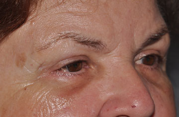 Facelift Before & After Image